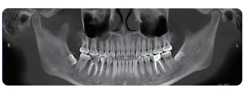 LargeV Smart3D-X
