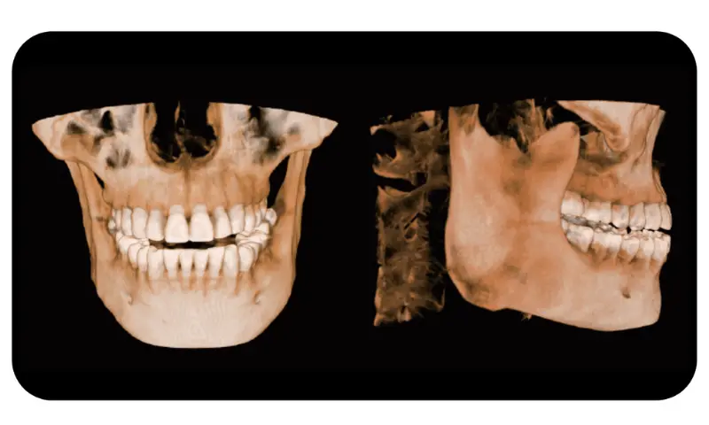 CBCT