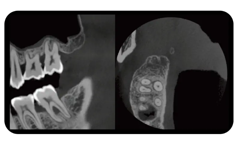 CBCT