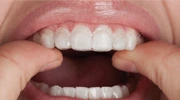 Opalescence PF 16% Kit Paciente